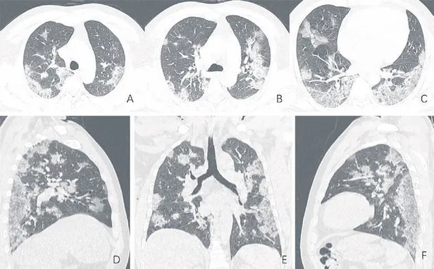 Coronavirüs (COVID-19) hastalarının akciğerlerinde buzlu cam benzeri yapılar tespit edildi-2