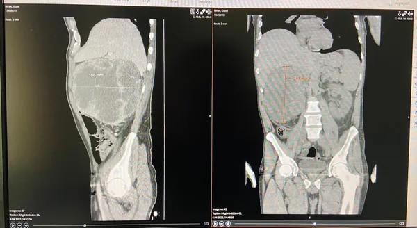 halsizlik-ve-bas-donmesi-sikayetiyle-gitti-karnindan-20-santimlik-kitle-cikarildi-1649935746279.jpg Halsizlik ve baş dönmesi şikayetiyle gitti karnından 20 santimlik kitle çıkarıldı-9