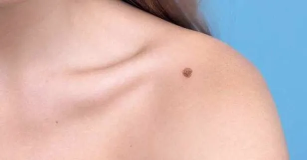 Vücuttaki benler, kimi zaman cilt kanserini gizliyor!