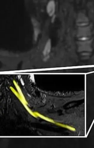 SON DAKİKA: Bilim insanları ilk kez görüntüledi! İşte yeni tip koronavirüsün sinir sisteminde yarattığı hasar