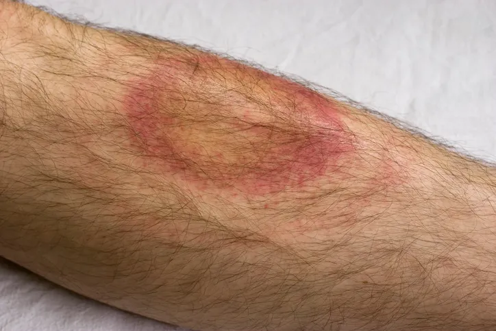 Lyme hastalığı nedir? AIDS'ten bile tehlikeli olan lyme hastalığı bulaşıcı mıdır? Lyme hastalığı tedavi edilebilir mi?  - 1
