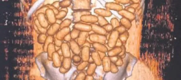 Midede kapsül kapsül eroin