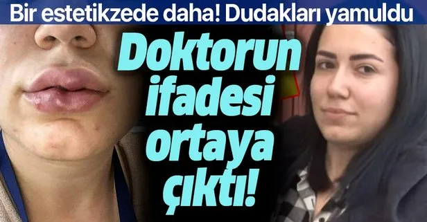 24 Yasindaki Ece Deniz In Dudagi Dolgu Sonrasi Yamuldu Supheli Doktorun Verdigi Ifade Pes Dedirtti Takvim