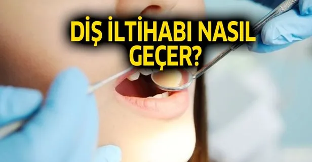Dis Apsesi Nedir Dis Iltihabi Nasil Gecer Iste Evde Dogal Yontemleri Takvim