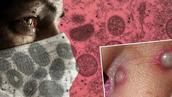 son-dakika-bakan-kocadan-flas-maymun-cicegi-aciklamasi-turkiyede-ilk-vaka-1656571693936.jpg SON DAKİKA! Bakan Koca'dan flaş maymun çiçeği açıklaması! Türkiye'de ilk vaka! Maymun çiçeği hangi ilde görüldü?-6