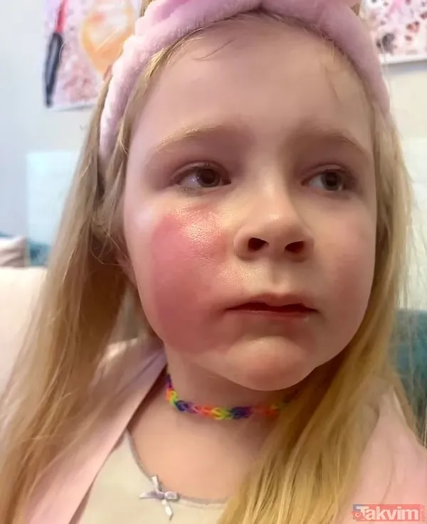 ⚠️ Popüler makyaj ürünü tehlike saçıyor! Annesinin öpücüğü küçük kızın yüzünde yanığa neden oldu - 4