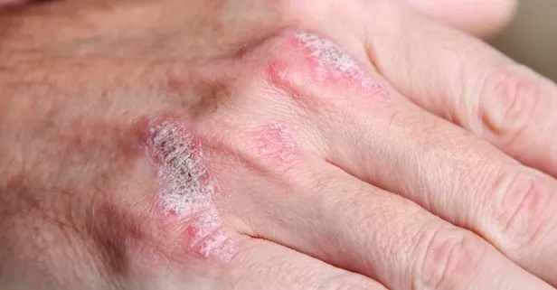 Sedef hastalığına karşı uyaran uzmanlar hangi besinleri öneriyor?