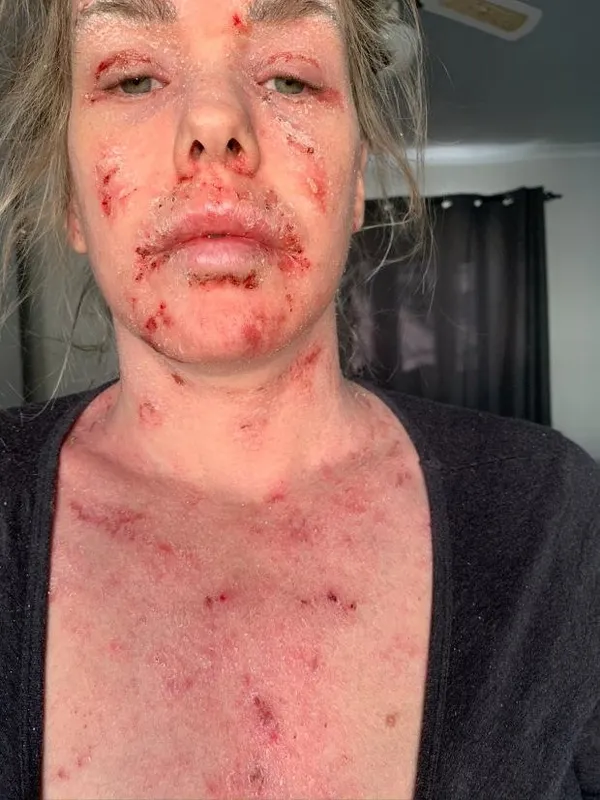 Güney Afrika’da yaşayan Samantha Saunders'ın hayatı bir krem ile değişti! Sebebini öğrenenler şoke oldu-8