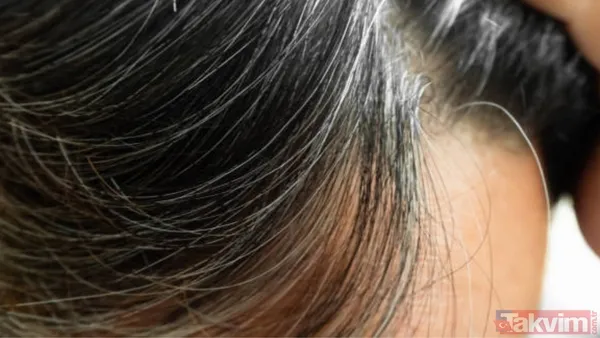 Saçlarınız neden erken beyazlıyor? Genetik mi, stres mi? Cevabı şaşırtacak… - 5