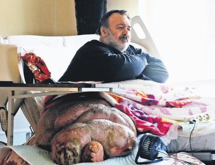 5 yıldır evden çıkamıyor! Tek bacağı 130 kilo!