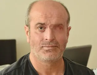 Hiç tanımadığı biri yüzüne kezzap attı