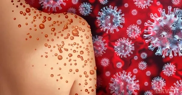 Küresel maymun çiçeği vakalarında artış! DSÖ son verileri duyurdu: Maymun çiçeği nasıl yayılıyor? Hastalığın belirtileri neler? - 1