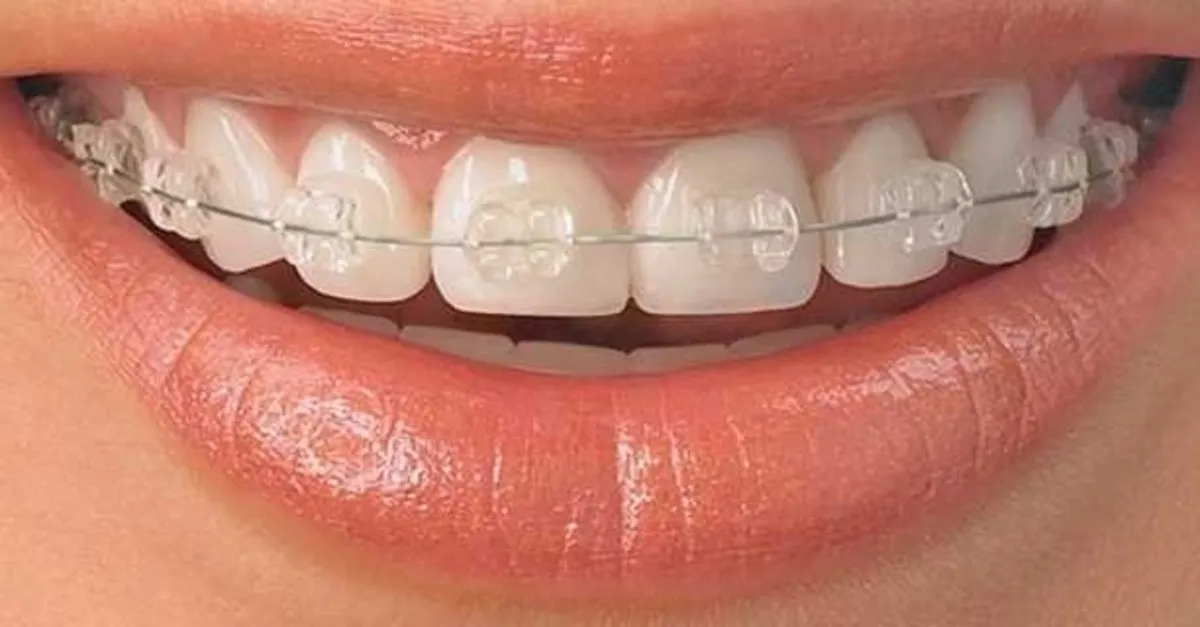 sgk dis teli tedavisi fiyatini