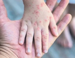 El ayak ağız hastalığında ebeveynlere 5 kritik uyarı