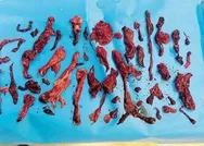 İşte koronavirüsün ciğerlerimize etkisinin en net görüntüsü! İki doz aşı olsanız bile Delta varyantı...