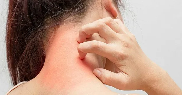 Uzmanlar, şekerli ürünlerin bu hastalığı tetikleyebileceğini söylüyor! Egzamaya dikkat