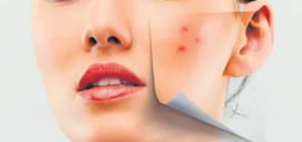 Yazın oluşan lekelere sonbaharda veda edin