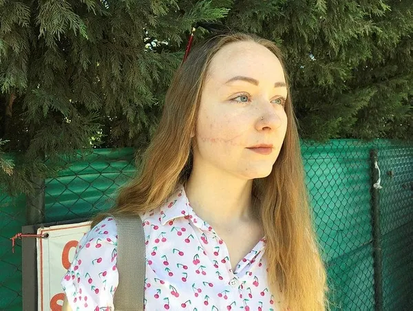 Eşi falçatayla saldırdı Ukraynalı Hanna Butym'un yüzünün bir kısmı felç kaldı!-4