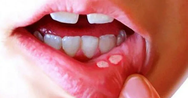 Aft çıkarsa yapmanız gerekenler! Aft nedir? Aft nasıl tedavi edilir?