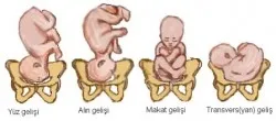 ters-dogum-nedir-dogum-kocu-evde-dogum-yaptirdi-ters-gelen-bebek-oksijensizlikten-oldu-1641993103169.jpg Ters doğum nedir? Doğum koçu evde doğum yaptırdı! Ters gelen bebek oksijensizlikten öldü-12