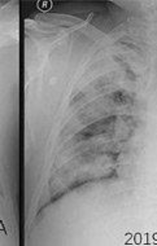 Türkiye'de bir ilk! Koronavirüsü nasıl geçireceğimizi öğrenmek artık mümkün!