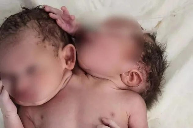 Doktorlar gözlerine inanamadı! Çift başlı üç elli bebek doğdu
