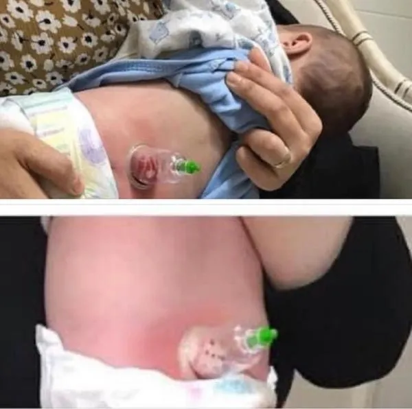 Sosyal medyadaki hacamat görüntüleri olay yarattı: Bebeklere bile yaptılar! Uzmanlardan kritik uyarı-2