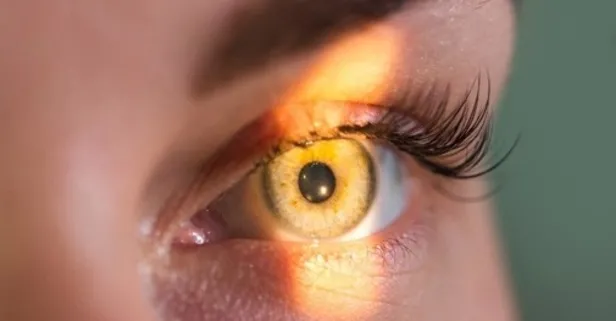 İşte sarı nokta hastalığını tetikleyenler...