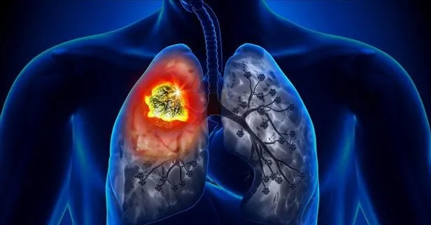 Akciğer kanseri keser nefesi! 50 yaşın üzerindekiler dikkat!