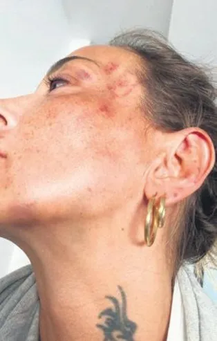 Bursa Osmangazi'de Burcu Can Eşmen eski sevgilisi tarafından öldüresiye darp edildi