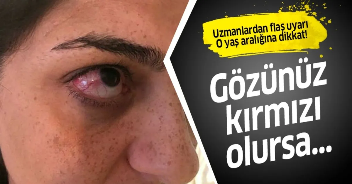 Tatilcilere Kirmizi Goz Hastaligi Uyarisi Takvim