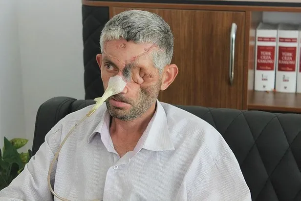 Dişini çektirdikten sonra gözünü kaybettiği ileri sürülen Mustafa Bulat'ın gözünü kanserden baybettiği ortaya çıktı-1