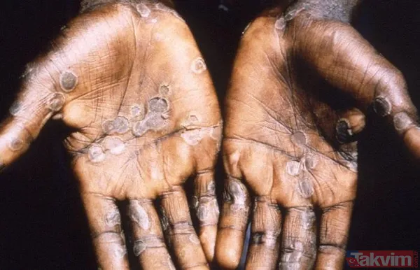 Maymun çiçeği nedir? Belirtileri neler? Çiçek aşısı Maymun çiçeğinden korur mu? Türkiye’de vaka görüldü mü? Sağlık Bakanlığı açıkladı - 12