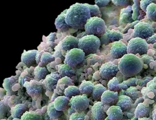 Prostat kanserine dikkat