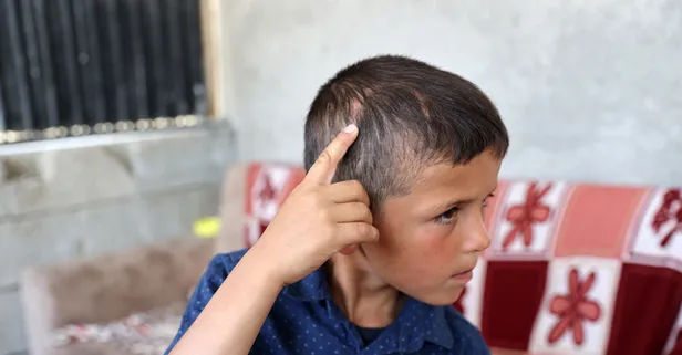 Başıboş köpekler saldırmıştı! 7 yaşındaki minik Emir 6 kez ameliyat oldu: Köpek kafamı ve burnumu ısırdı