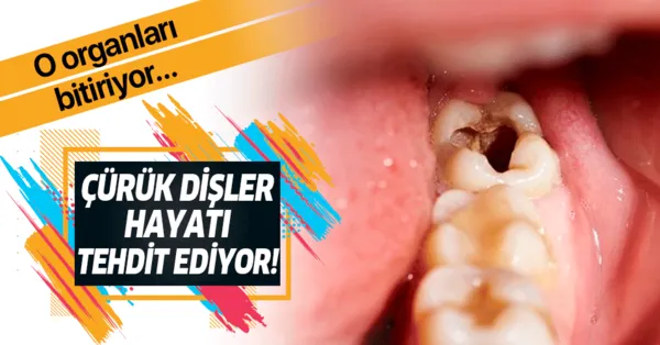 Curuk Disler Hayati Tehdit Ediyor Kalp Mide Ve Bobrekleri Vuruyor