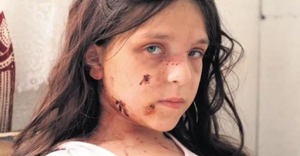 Pitbull, küçük kızın yüzünü parçaladı