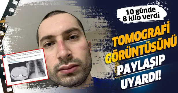 Koronavirüse yakalanan genç doktor 10 günde 8 kilo verdi! Tomografi görüntüsüyle uyardı!