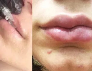 24 yaşındaki Ece Deniz’in dudağı dolgu sonrası yamuldu!