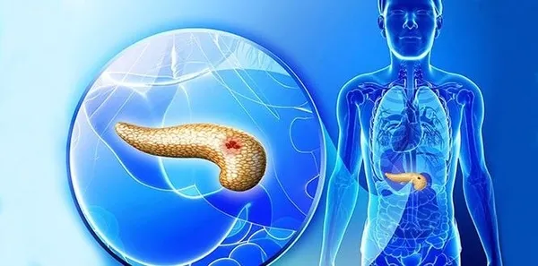 Pankreas kanserini yanlış anlama: Pankreas kanserinin belirtileri nelerdir?-4