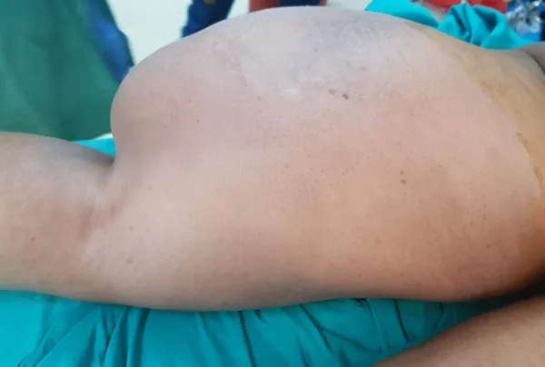 diyarbakirda-72-yasindaki-kadin-korona-nedeniyle-15-yil-hastaneye-gitmedi-uylugundaki-5-kiloya-ulasan-tumor-ameliyatla-alindi-1624006133305.jpg Diyarbakır'da 72 yaşındaki kadın korona nedeniyle 1,5 yıl hastaneye gitmedi! Uyluğundaki 5 kiloya ulaşan tümör ameliyatla alındı-8