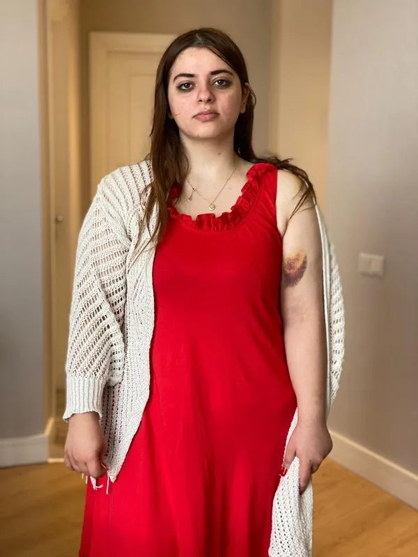 istanbul-beylikduzunde-urdunlu-kadin-eski-nisanlisi-ve-arkadasi-tarafindan-saldiriya-ugradi-saldirgan-tutuklan-1655798979578.jpg İstanbul Beylikdüzü'nde Ürdünlü kadın eski nişanlısı ve arkadaşı tarafından saldırıya uğradı saldırgan tutuklandı! 'Beni dövdüler kollarımı ısırdı'-2