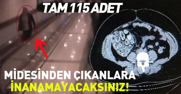 Brezilyalı kadının midesinde kokain dolu 115 prezervatif çıktı