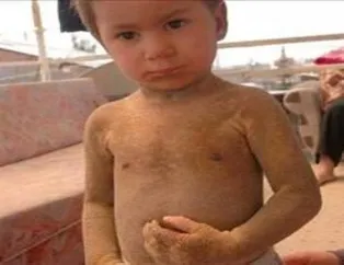 Vücudu timsaha benzeyen Dila'nın dramı