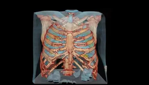 Koronavirüsün son hali görenleri korkuttu! Kıla benzer enfekte hücreler...-3