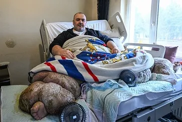 300 kiloya ulaşan fil hastası Engin Akbadal özel ekiple evden çıkarıldı Ankara’ya sevk edildi