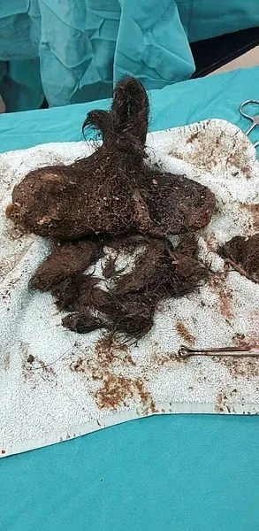 Kayseri'de bir hastanın midesinden tam 700 gram kıl çıktı!-3