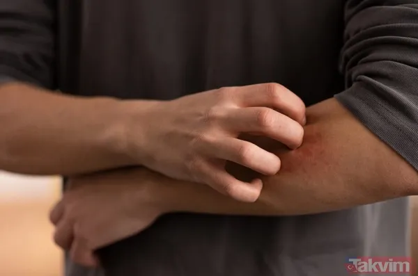 Geçmeyen vücut kaşıntısının sebebi bu olabilir - 3