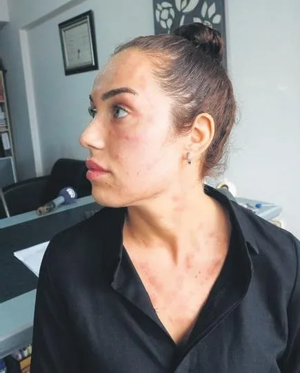 Yer Izmir Cildine Yaptirdigi Genclik Asisi Kabusu Oldu Yuzunde Ve Boynunda Noduller Olustu Takvim