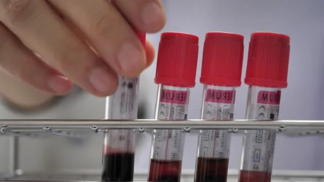 bu-kan-grubundakiler-celik-gibi-vucuda-sahip-en-sanssiz-kan-grubu-belli-oldu-bu-kisilerin-kanser-olma-riski-1700942124685.jpg Bu kan grubundakiler çelik gibi vücuda sahip! En şanssız kan grubu belli oldu! Bu kişilerin kanser olma riski...-2